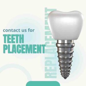 Teeth implantation services in UK